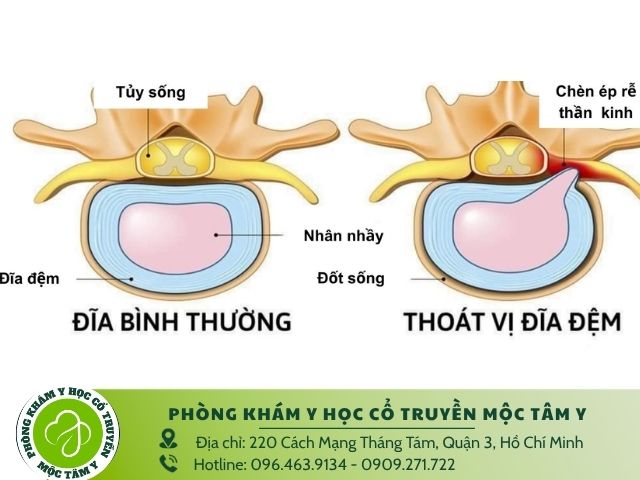 Bệnh thoát vị đĩa đệm là gì