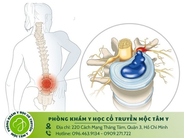 Đối tượng nào dễ bị thoát vị đĩa đệm
