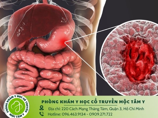 Trào ngược dạ dày là gì